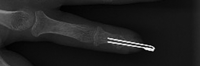 PSORIATIC ARTHRITIS | Hand Surgery Resource